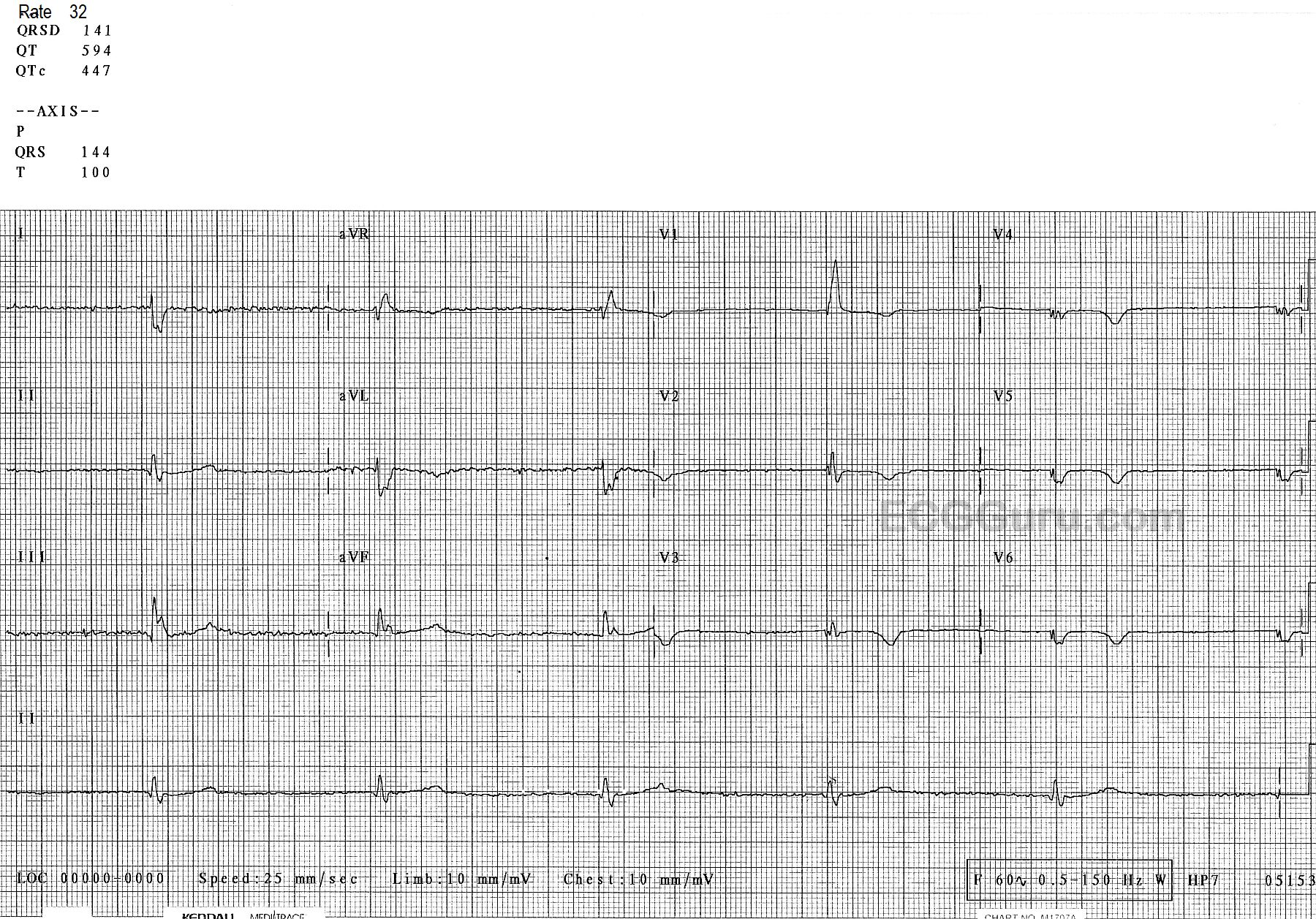 marked-bradycardia-with-bifascicular-block-ecg-guru-instructor